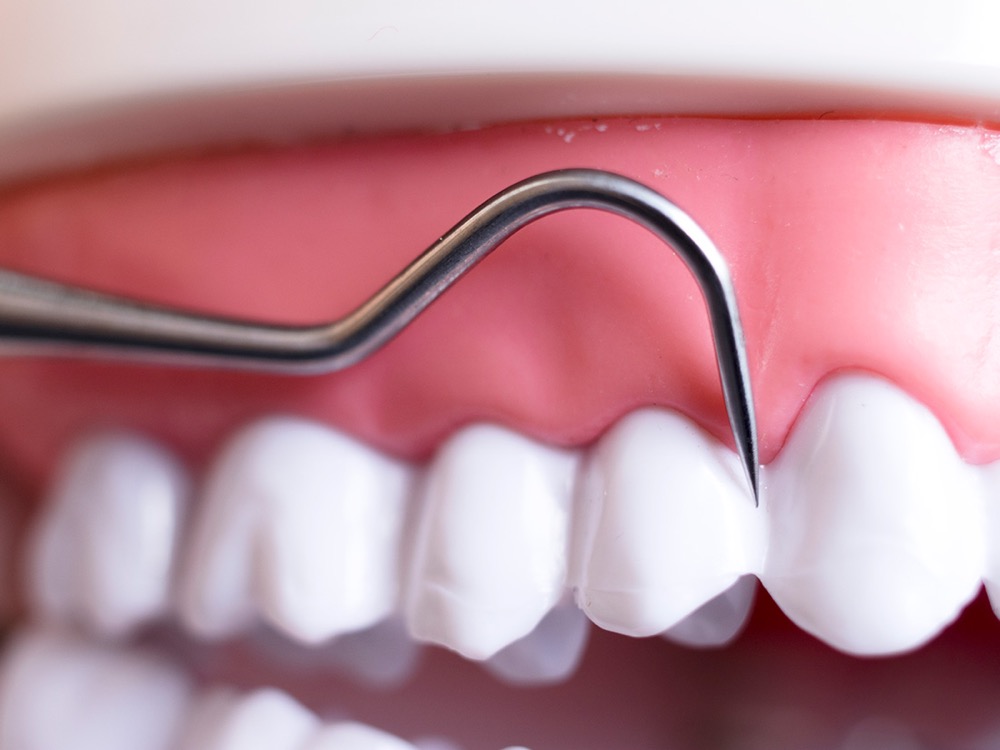 Diş Taşı Temizliği